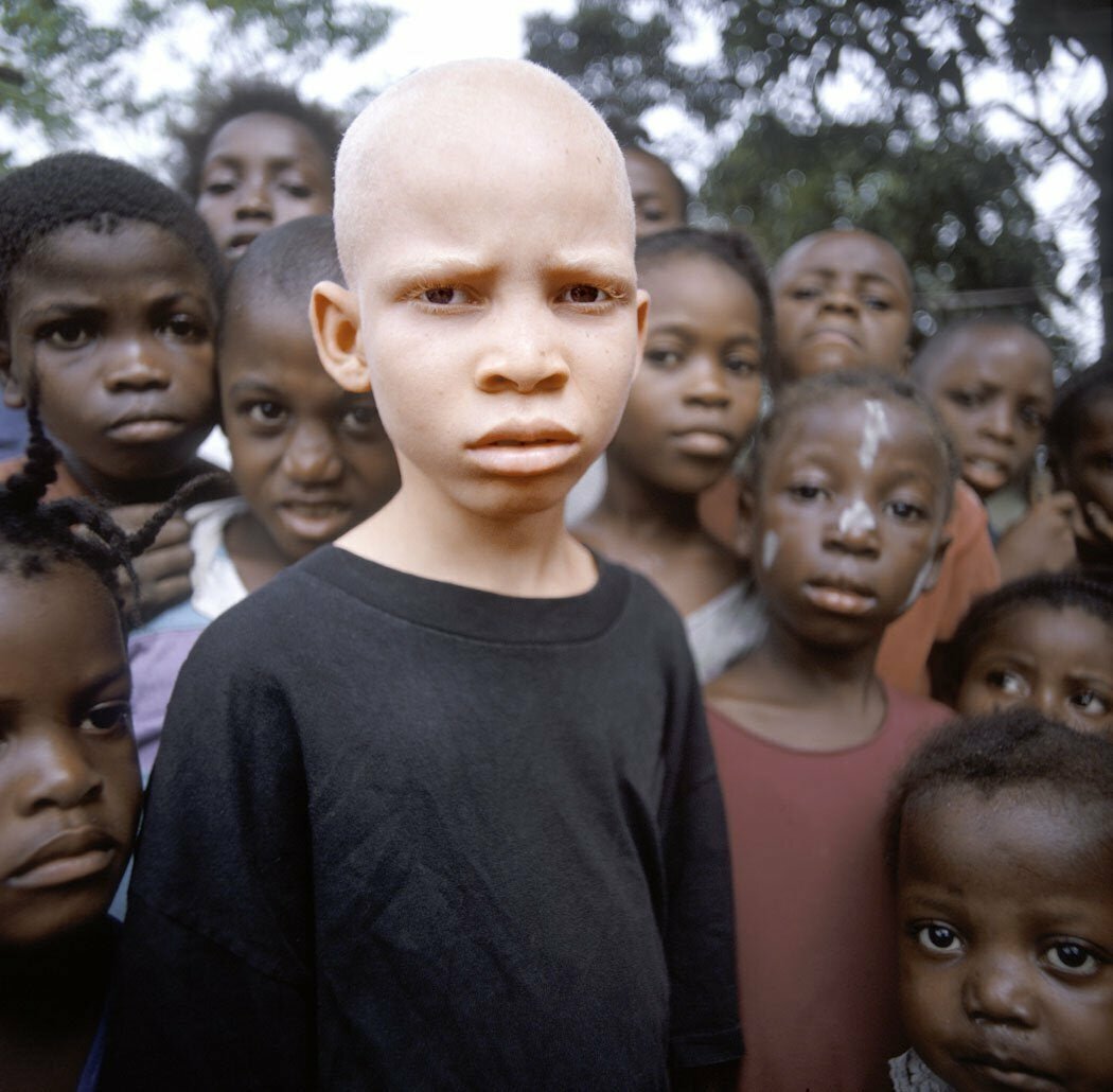 Еще одна грань безнадежности - родиться альбиносом в Африке.