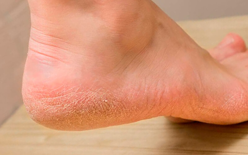 Проблемные трещины на пятках