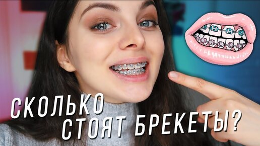 Télécharger la video: СКОЛЬКО СТОЯТ БРЕКЕТЫ? / ПЕРВЫЕ ДНИ С БРЕКЕТАМИ