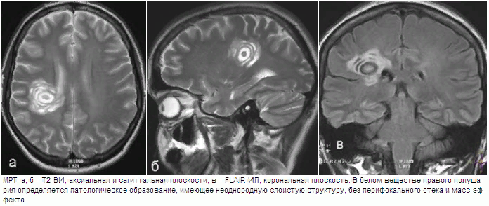 Картина демиелинизирующего процесса головного мозга мр