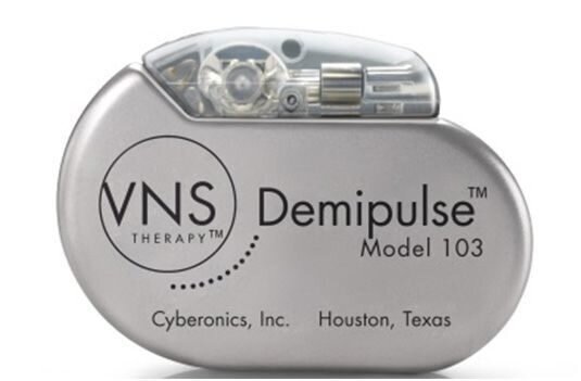 Стимуляция блуждающего нерва для лечения эпилепсии и депрессивных ...