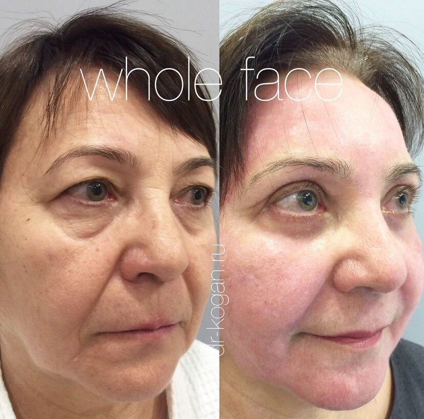 Блефаропластика верхних и нижних век с фракционным лазерным омоложением СО2. Фото до и после. Фото предоставлено врачом дерматологом косметологом клиники Д.Р. Гришкяна - Коган Л.С. Имеются противопоказания, требуется консультация специалиста