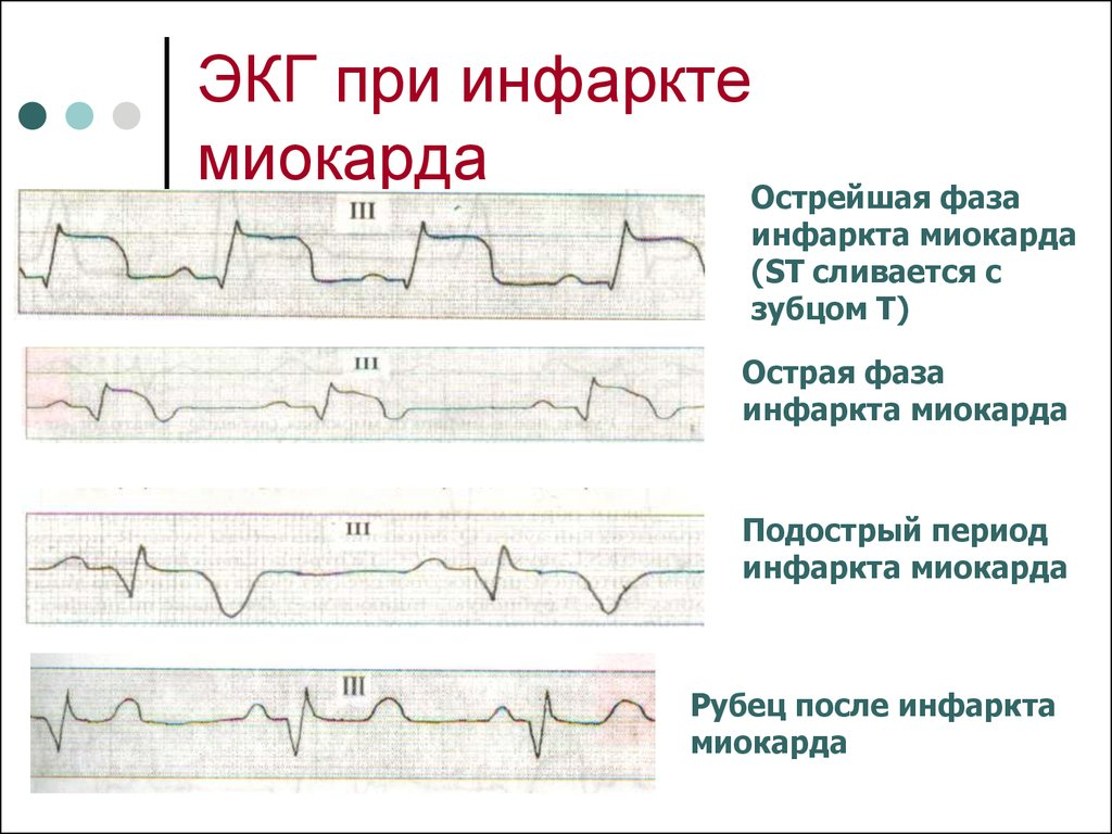 Острый инфаркт миокарда ЭКГ расшифровка. Расшифровка ЭКГ при инфаркте миокарда. ЭКГ сердца при инфаркте миокарда. Острая стадия инфаркта на ЭКГ.