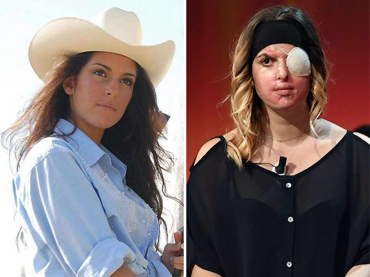 Итальянскую модель и финалистку конкурса «Мисс Италия 2007» Джессику Нотаро облил кислотой бывший возлюбленный. После непродолжительного романа девушка решила порвать с молодым человеком, но она и подумать не могла, что он будет способен на такую жестокость. В результате трагедии Джессика получила сильные химические ожоги лица, тела и глаз. Сегодня девушка тратит примерно 800 евро в месяц (около 40 000 рублей) на лекарства, которые помогают ей справиться с болью. Пластическую операцию ей можно будет провести только через год, когда организм немного окрепнет. Недавно Джессика пришла на телешоу, где впервые сняла с лица платок, и обратилась к «злополучному» бывшему: «Я хочу, что ты увидел, что сделал со мной. Это не любовь».