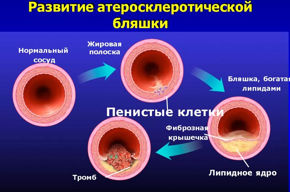 Стадии атеросклероза картинки