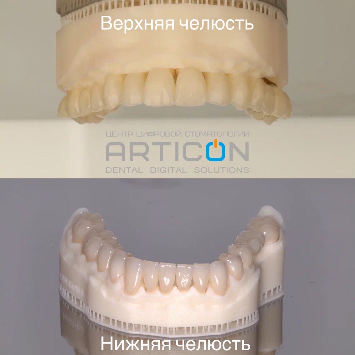 Я счастлива! Вы сделали меня не только здоровой, но и красивой!» Ощущения  пациентки после имплантации и протезирования зубов | ARTICON цифровая  стоматология в Москве | Дзен