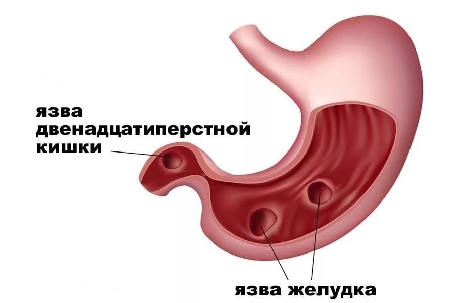 Язва желудка рисунок
