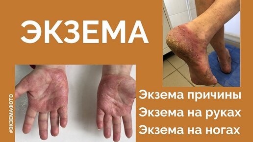 Экзема. Экзема на руках. Экзема на ногах. Экзема фото (часть 1)