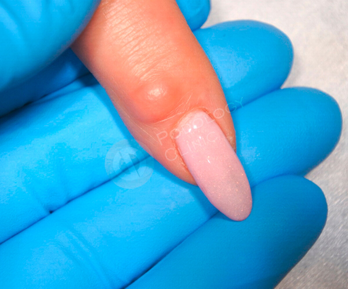 Случай из практики Клиники Подологии