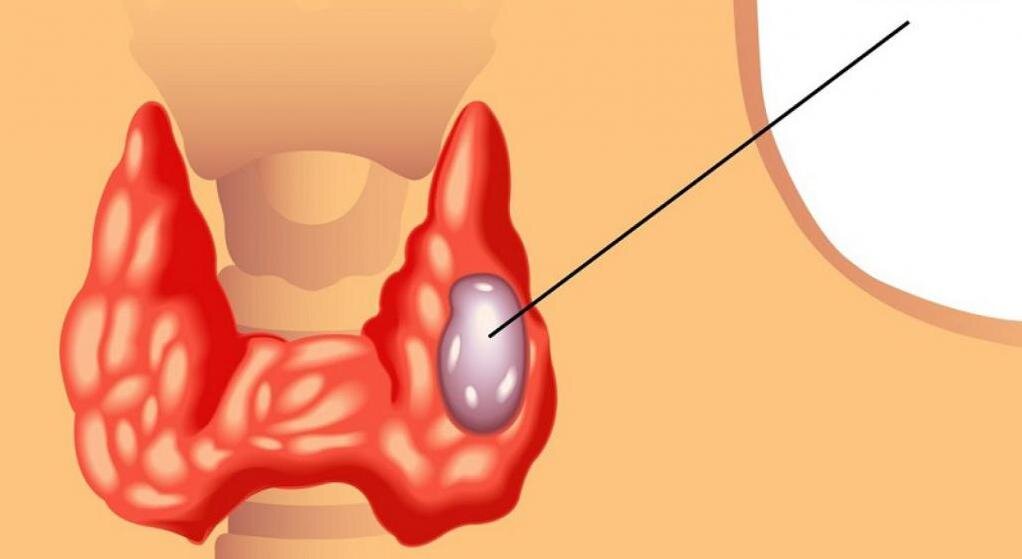 Что такое узловой зоб? Симптомы, причины и лечение узлового зоба