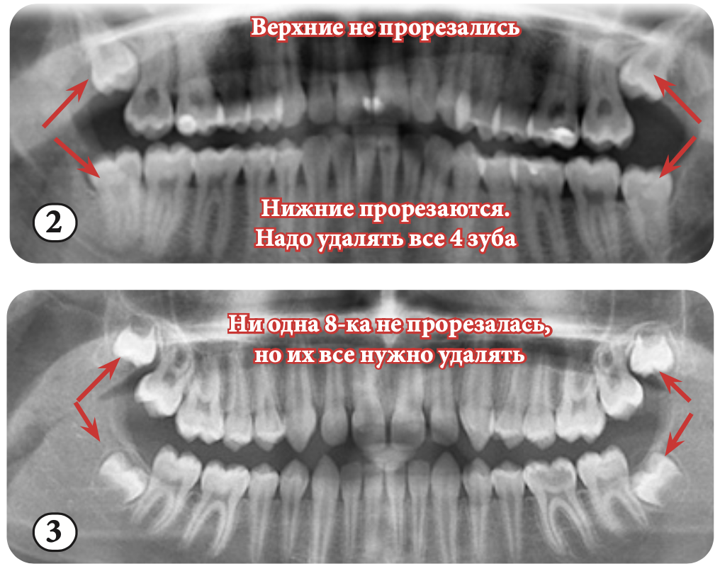 Седьмые зубы. Неизвестное новообразования рядом с зубом нижним. Белая полимерная полоска около 7 зуба после удаления 8 зуба