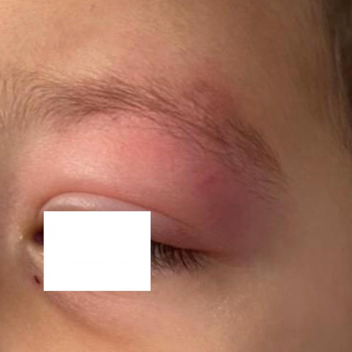 Синдром Скитера.