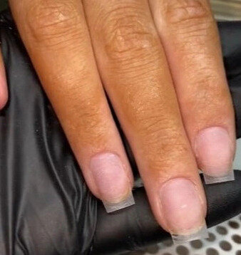    Ногти после удаления наращивания