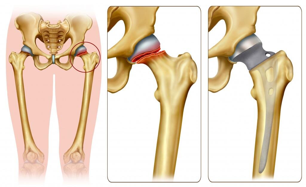 Сломана шейка бедра операция