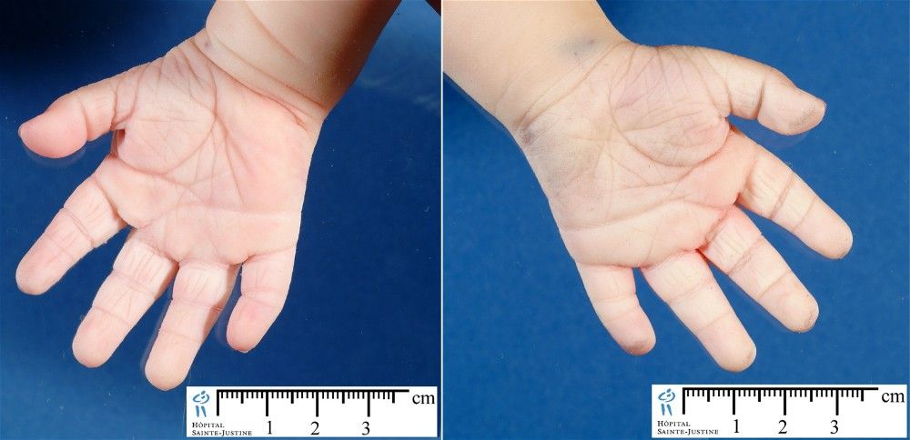 четырехпальцевая складка на ладони. ладонь человека с синдромом дауна. синдром дауна пальцы. сандалевидная стопа у дауна. линия симиан обезьянья ладошка.