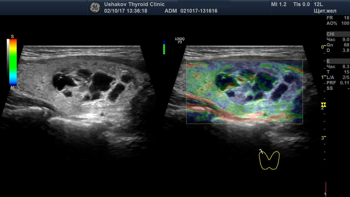 Эластография узлов щитовидной железы не улучшает диагностическую оценку. Достаточно внимательной оценки в обычной серой шкале