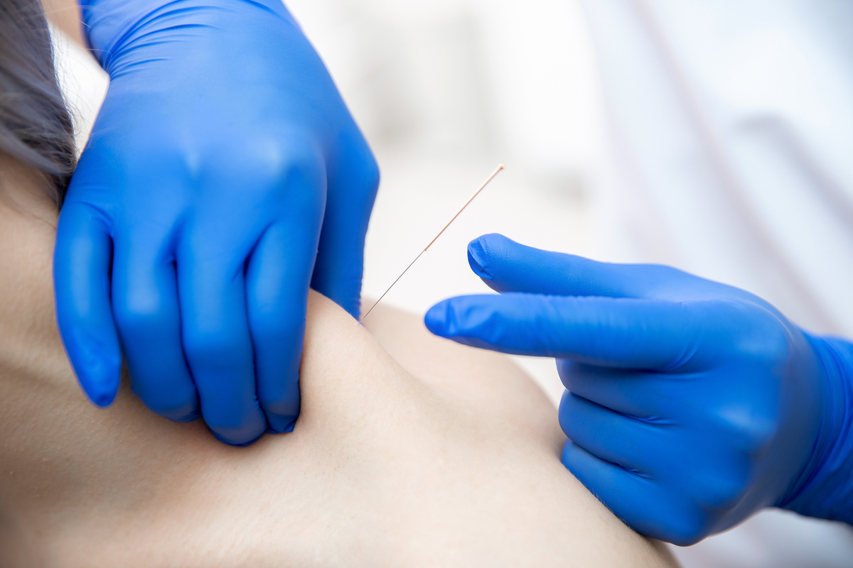 Как сухое иглоукалывание помогает избавиться от боли? | Ермаков Кирилл ...