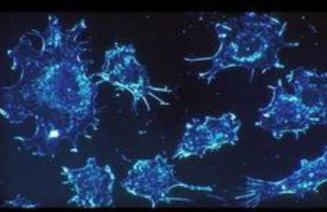 Что будет, если человеку с онкологическим заболеванием ввести в организм вирус оспы?

Пока ответ точно не известен, но есть аргументированное мнение, что определенный вирус оспы будет избирательно разрушать раковые клетки и не трогать здоровые. 

Я уже писал пост про вирусы «бактериофаги», которые помогают организму человека устранять болезнетворные бактерии и не трогать «хорошие и полезные» бактерии.

Так вот, вторая хорошая новость про вирусы состоит в том, что есть несколько вирусов, которые избирательно убивают  раковые (онко) клетки. Называются они онколитические вирусы.

Ваксиния или VAXinia (CF33-HNIs) - это разновидность "онколитического вируса" – вируса, встречающегося в природе и генетически модифицированного специально для борьбы с раком. 

Он разрабатывается  компанией Imugene Limited (Австралия), специализирующейся на новых методах лечения, которые активируют иммунную систему против рака.

"Наше предыдущее исследование показало, что аналитические вирусы могут стимулировать иммунную систему реагировать на рак и убивать его, а также стимулировать иммунную систему быть более чувствительной к другим методам иммунотерапии, включая ингибиторы контрольных точек", - сказал Даненг Ли, доктор медицинских наук, главный исследователь.

Пациенты начнут с приема низкой дозы ваксинии в виде инъекции непосредственно в опухоль или внутривенно. После этого они получат иммунотерапевтический препарат под названием пембролизумаб, который улучшает способность иммунной системы бороться с онко - клетками.

Ваксиния также повышает уровень белка под названием PD-L1 в опухолях, что делает иммунотерапию более эффективной. Ученые генетически модифицировали так называемый онколитический вирус, который встречается в природе. Они уже опробовали препарат на животных и теперь приступили к первой фазе клинических испытаний, она продлится два года.

Сто онкологических пациентов с метастатическими или солидными опухолями примерно в 10 испытательных центрах в США и Австралии. 

Оказывается, не всё так плохо с вирусами оспы🙂 Будьте здоровы!