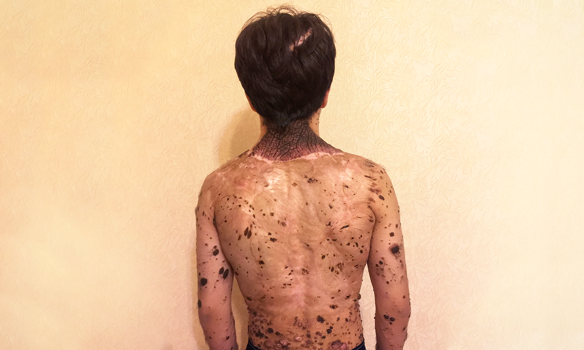 Адам Асиев, подопечный фонда "Алёша"