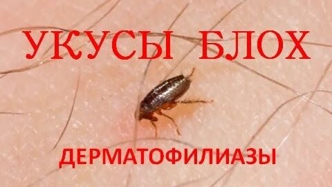 Укусы блох (Дерматофилиазы)