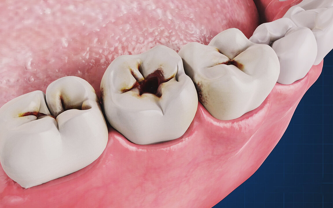 8 фактов о кариесе, которые полезно знать каждому | Стоматология ROOTT |  Дзен