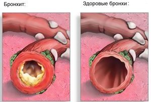 Бронхит: чем опасна болезнь и как ее лечить