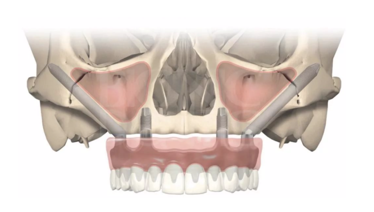 Скуловая имплантация верхней челюсти. Фото с сайта https://implantolog-fedorov.ru/uslugi/skulovaja-implantacija/