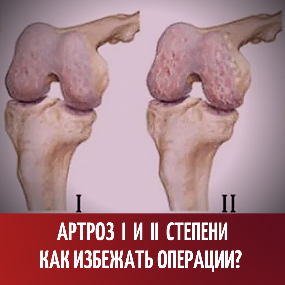 Как предотвратить артроз. Что такое артроз: виды и степени артроза суставов - АКАДЕМФАРМ Лечение суставов в Одессе, лечение артроза сустава Одесса Лечение гонартроза (артроза коленного сустава) | Med & Care