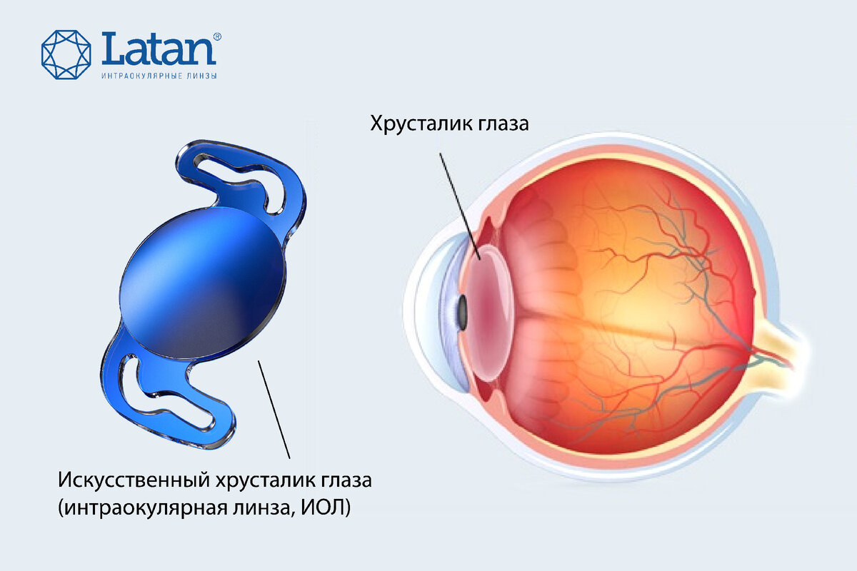 Какой он – искусственный хрусталик глаза? | Latan® Латан | Дзен