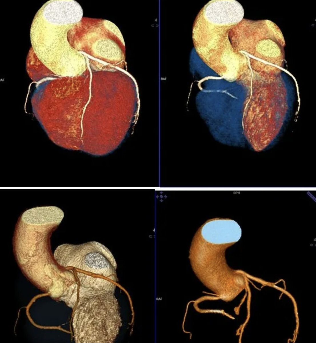 Кт-ангиография коронарных артерий. Мультиспиральная томография сердца и коронарных сосудов это?. Кт ангиография коронарных сосудов сердца. Компьютерная томография сердца. Что такое кт в медицине.