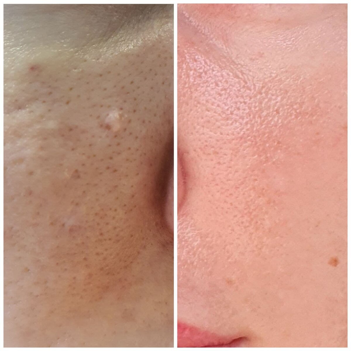 Уменьшение выраженности расширенных пор после подбора правильного очищения кожи