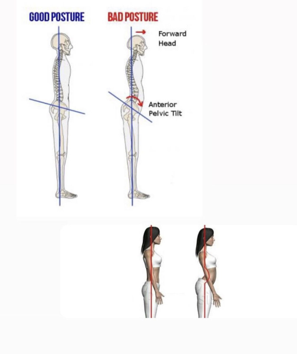 Упражнения от гиперлордоза в пояснице у женщин. Pelvic Tilt. Posterior anterior Tilt. Гиперлордоз. Anterior Pelvic Tilt.