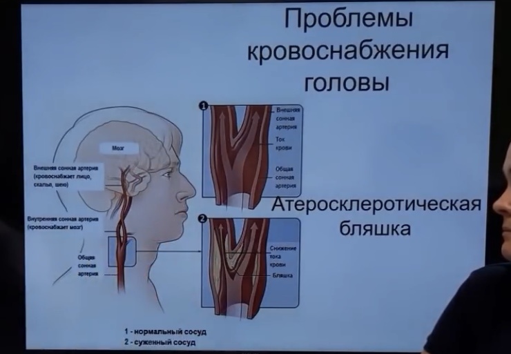Вот здесь указаны так называемые бляшки