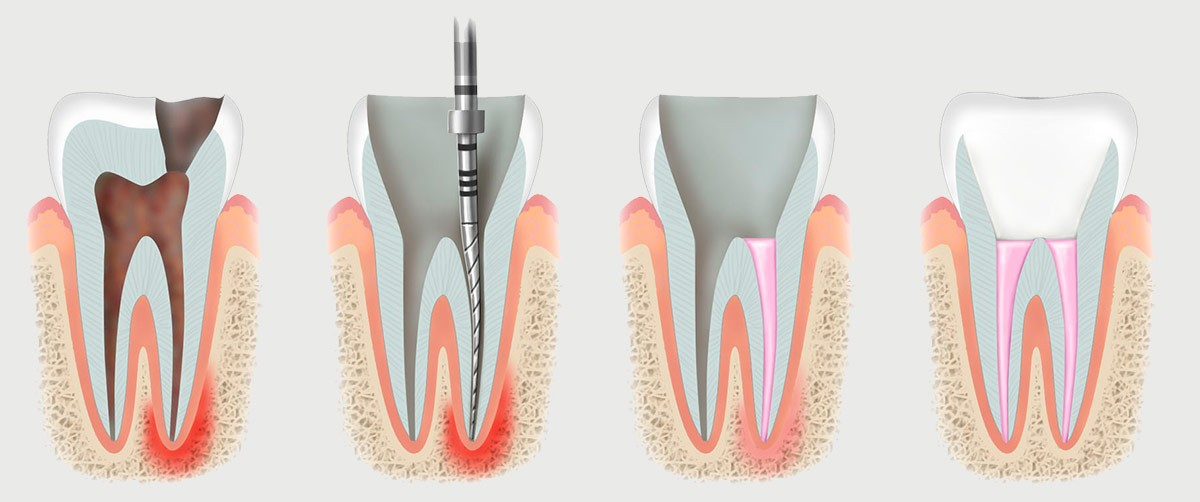🔎 Коротко В современной стоматологии мышьяк не применяют. Но иногда используют препараты со схожим принципом действия — на основе параформальдегида. Они убивают воспаленный «нерв» в зубе.-2