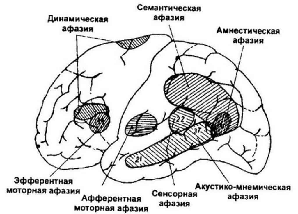 Формы афазий связанные с нарушением афферентных звеньев речевой системы презентация