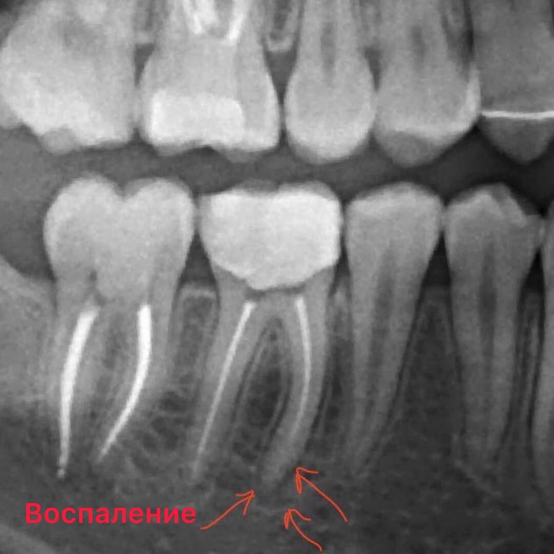 Некачественное лечение каналов привело к воспарению 