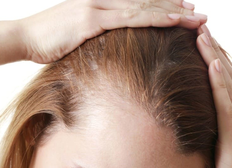 Как бороться с залысинами