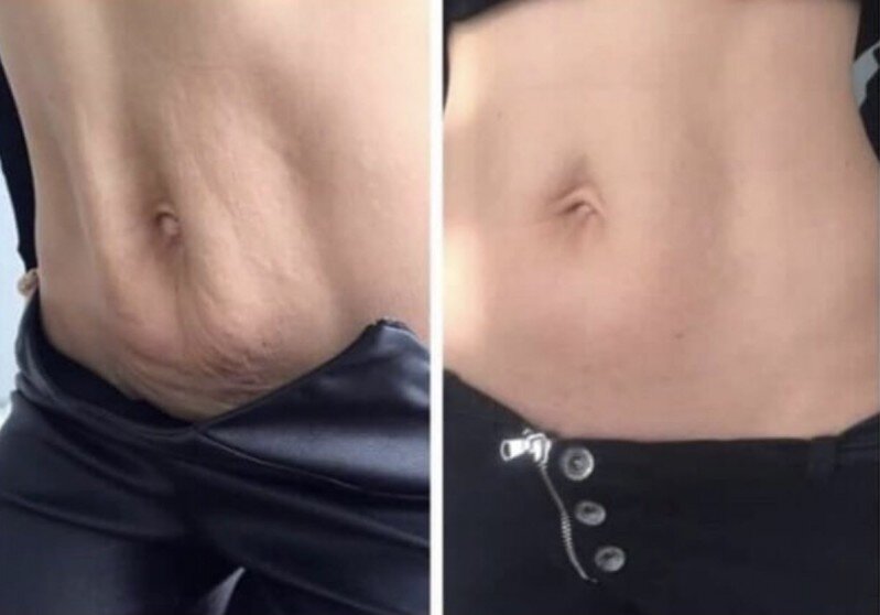 Нити в живот для подтяжки. Нити в живот для подтяжки. Нити в живот для подтяжки. Абдоминопластика живота и маммопластика. Подтяжка живота мезонитями.