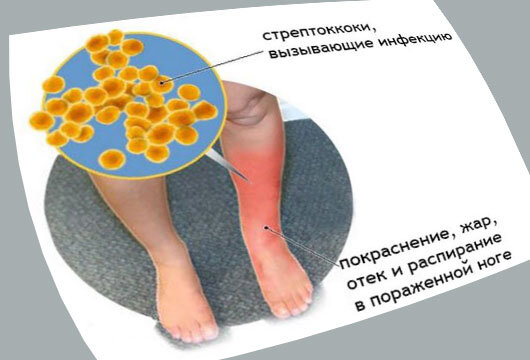 Как лечить рожистое воспаление на ногах народными средствами