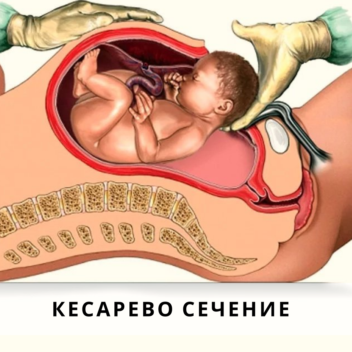 Кесарево сечение – это серьезная операция, при которой разрезаются ткани брюшины и матки, страдают органы малого таза, фасции, после чего образуются спайки и рубцы, стягивающие всю грудную клетку и живот на себя. Ребёнка при этом вытягивают за голову. Ни о какой естественности речи не идёт. Кесарево сечение – травматичная операция для обоих, поэтому она должна делаться по серьезным показаниям, когда потенциальная польза превышает потенциальный риск. 
Некоторые женщины ошибочно полагают, что можно избежать множества проблем, если ребёнок не совершит свой путь по родовым путям. Они думают, что так можно избежать родовых травм. Всё с точностью до наоборот. А некоторые и вовсе из страха перед родовой болью настаивают на эпидуральной анестезии, даже не догадываясь какую "медвежью услугу" оказывают сами себе.

Естественные роды – самое лучшее, что может случиться с женщиной и ребёнком в конце беременности. Так задумала природа. И чем естественнее пройдут роды (без дополнительной стимуляции и вмешательства), тем с меньшими потерями роды закончатся.

В идеале естественные роды начинаются тогда, когда организм матери ребёнка к ним готов. Это происходит постепенно. О патологиях мы сейчас не говорим. Когда проводится кесарево сечение, о готовности речи не идёт. А значит и последствия "разгребать" придётся ещё долго, а скорее всего, как показывает моя практика, они не проходят сами по себе и вовсе.

Повторюсь, кесарево сечение – серьезная операция, которая применяется на основе веских оснований, в ситуации, когда естественные роды опасны.

У детей, рождённых путём КС намного чаще встречаются родовые травмы, повреждения спинного мозга и мозговых оболочек, смещение костей и даже их переломы.

В естественных родах у ребёнка, проходящего по родовым путям запускается дыхательная и сердечно-сосудистая системы, а вот при кесаревом сечении этого не происходит, сразу из матки малыш попадает в наш мир.

Женщины и дети, прошедшие через КС – это отдельная категория, нуждающаяся в более тщательном остеопатическом осмотре и коррекции. Остеопатия позволяет привести организм малыша в то нормальное состояние, при котором он будет иметь возможность правильно расти и развиваться, а женщина сможет восстановиться.

А у вас были ЕС или КС?