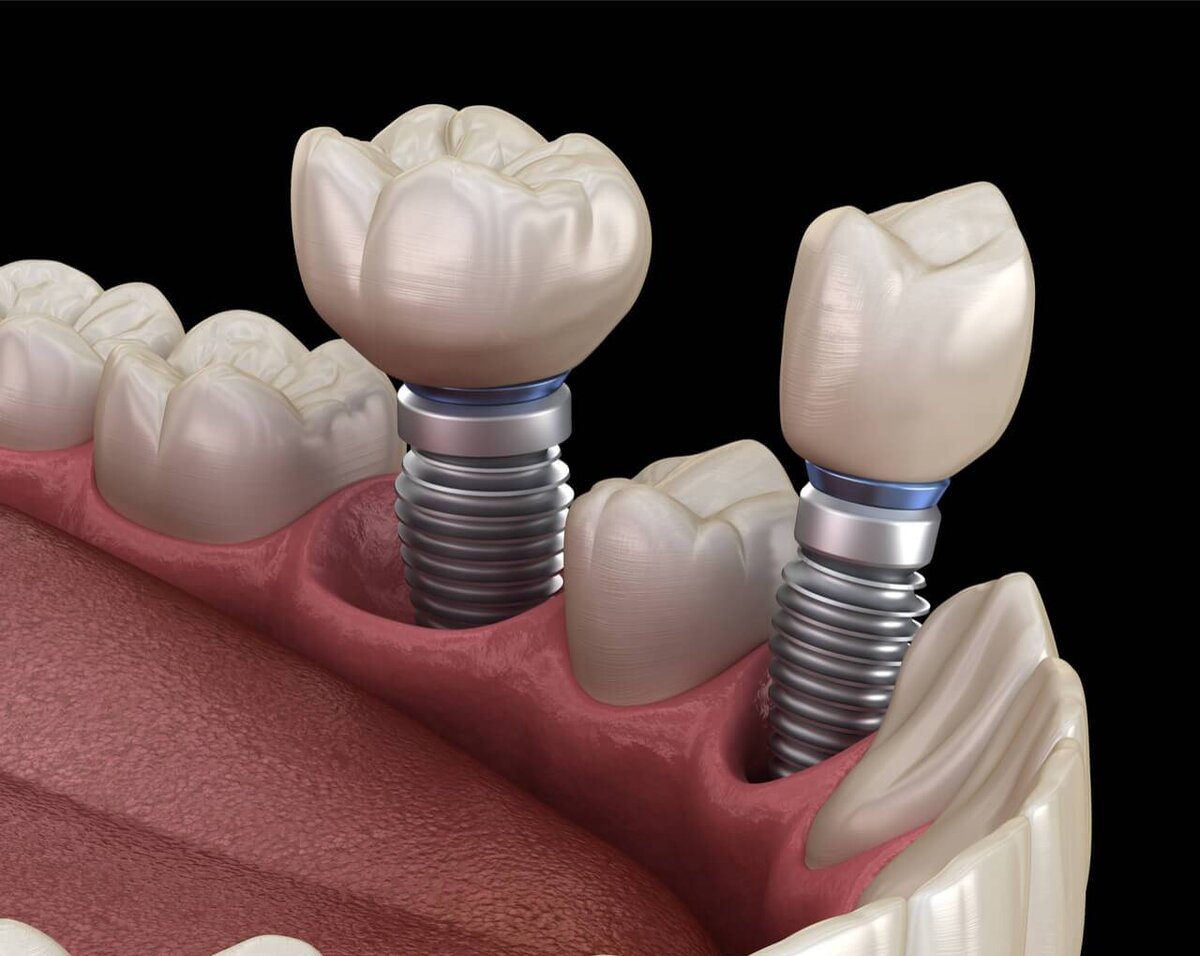 Можно ли на один имплант поставить два зуба? | Стоматология ЭверестДент | Дзен