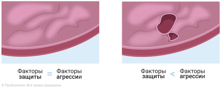 Язва желудка, симптомы язвы - Клиника Здоровье г. Екатеринбург