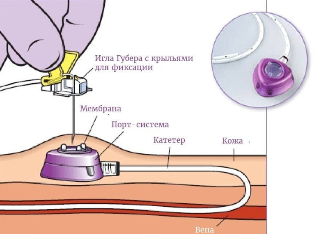 Порт система фото Как облегчить процесс химиотерапии? Онколог Базылев Дзен