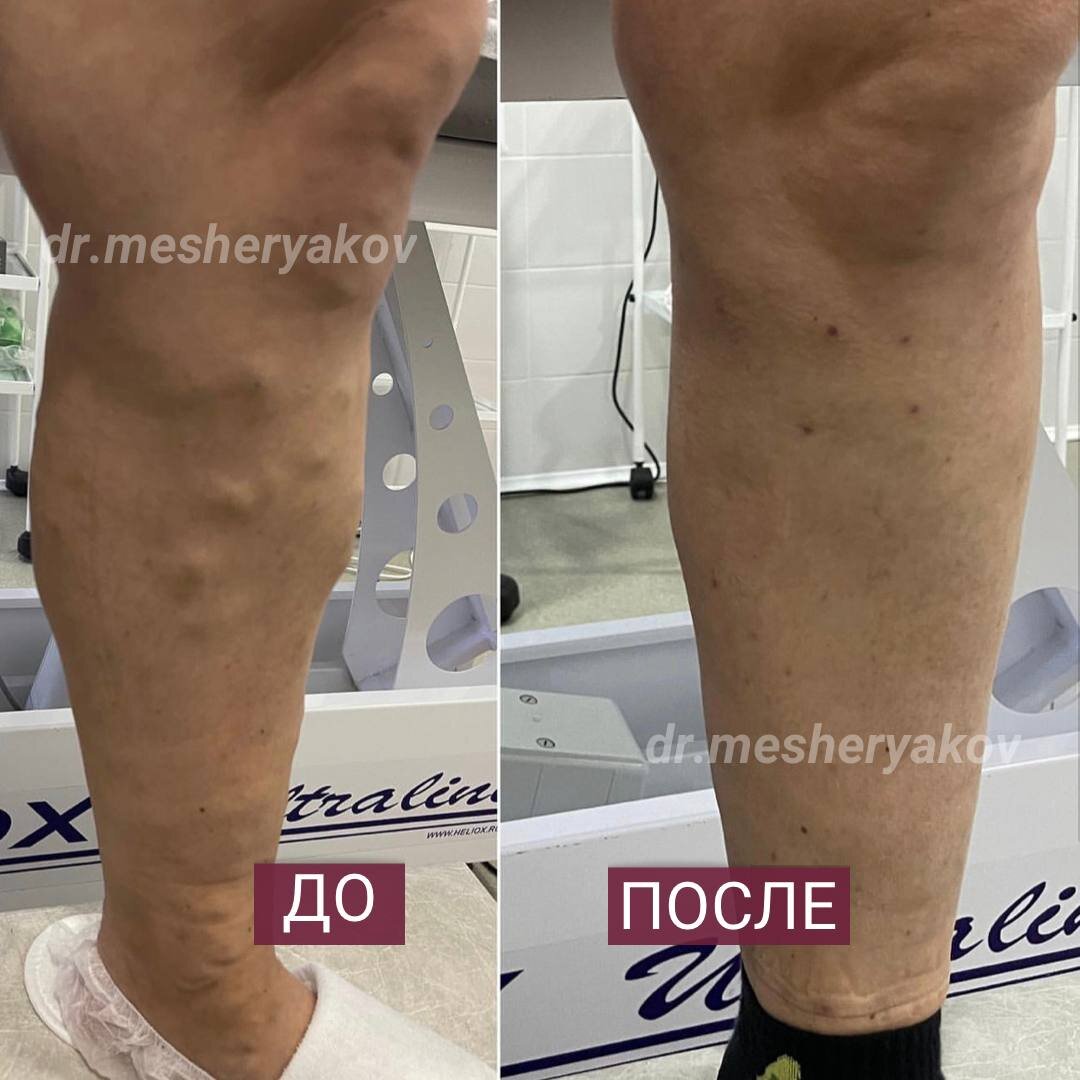 Ножки моей пациентки после проведенного лечения.