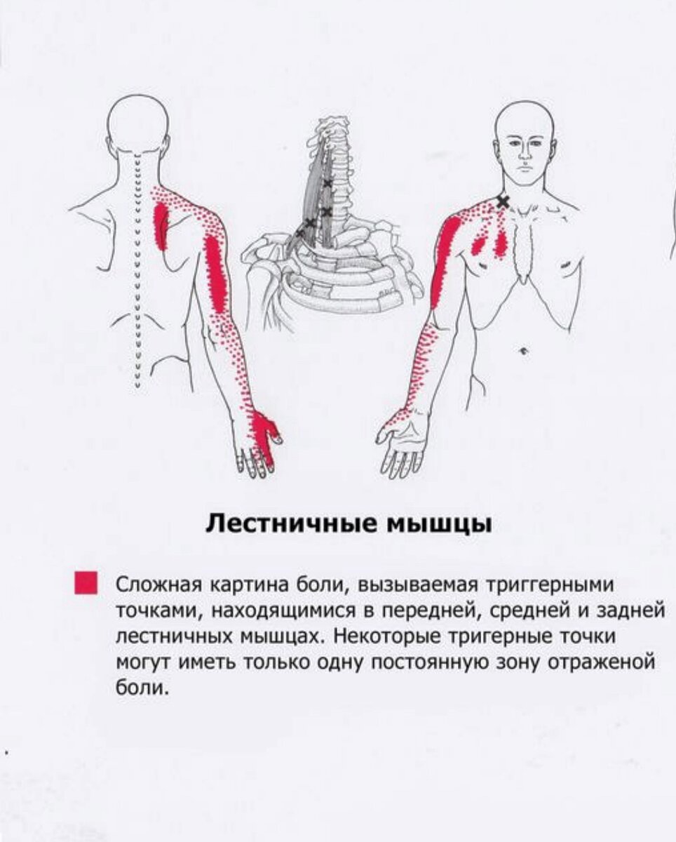 Где находится лестничная мышца у человека картинки