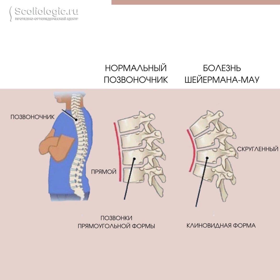 Степени кифоза грудного отдела позвоночника. Шермана МАУ позвоночника. Болезнь Шейермана МАУ рентген.