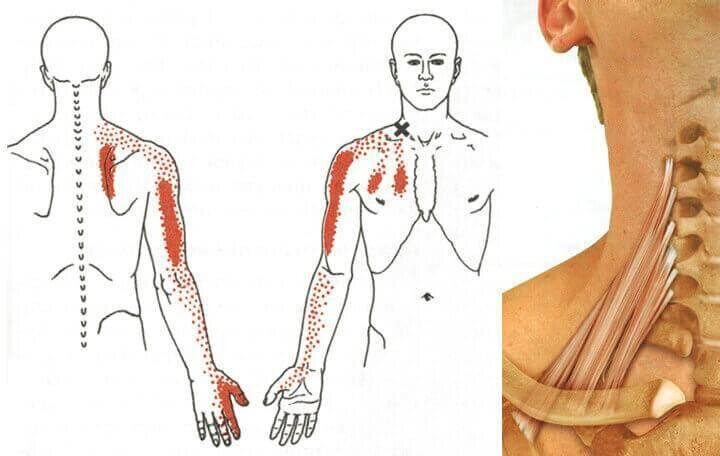 Подключичная мышца триггерные точки