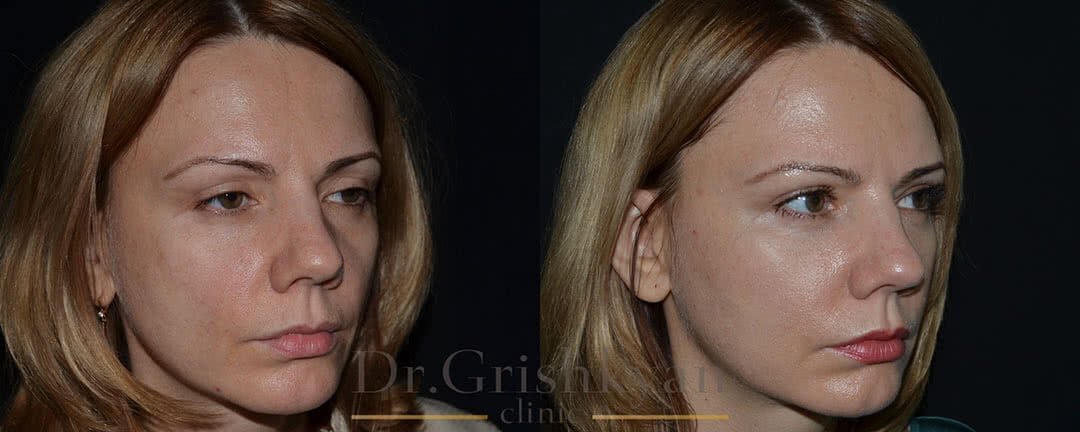 Липофилинг лица омоложение фото до и после. Фото с сайта Д.Р. Гришкяна. Имеются противопоказания, требуется консультация специалиста