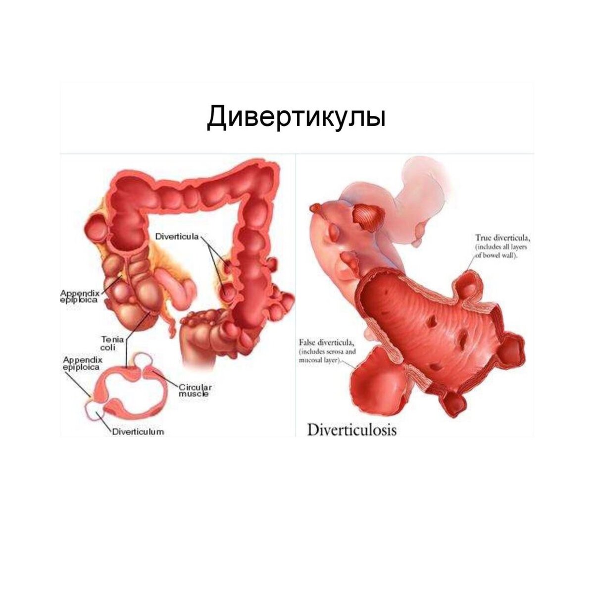 В настоящее время остается темой многочисленных дискуссий, семинаров, конференций, в связи с тем, что проблема окончательно не решена.

 Дивертикулы – это мешочкообразные выпячивания стенки кишки, формирующиеся в «слабых» местах кишечной стенки. Существуют истинные дивертикулы, имеющие в строении все слои кишечной стенки и ложные – в которых отсутствует мышечный слой. В дивертикуле различают устье, шейку тело и дно дивертикула. Кровоснабжение дивертикула осуществляется из сосудов подслизистого слоя от которого отходят тонкие сосудистые ветви, прободающие стенку кишки и направляющиеся ко дну дивертикула.