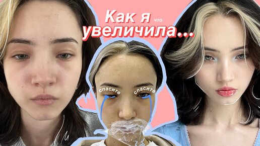 Как я увеличила губы (нервно)